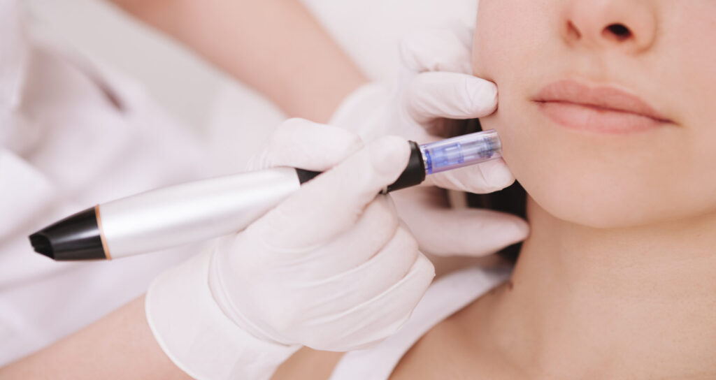 Cropped close up of woman getting microneedling procedure at medspa