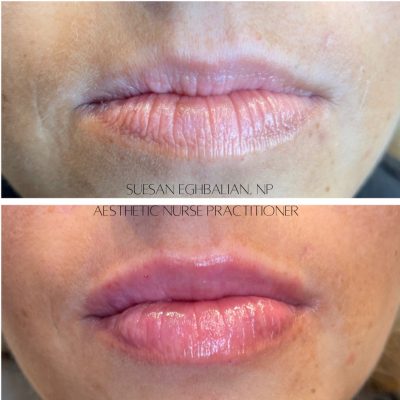 Lip Care Before & After Image | Rosewater Aesthetics in Clarkston, MI