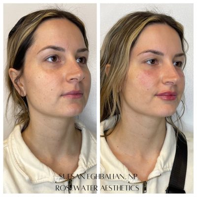 Face Treatment Before & After Image | Rosewater Aesthetics in Clarkston, MI