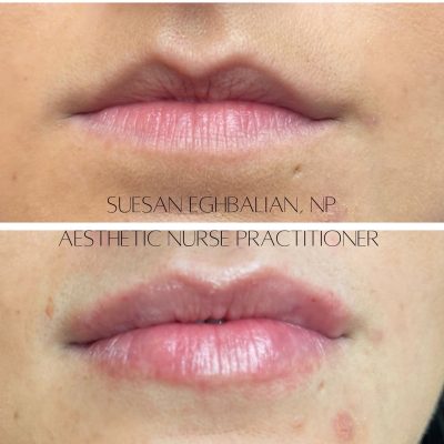 Lip Care Before & After Image | Rosewater Aesthetics in Clarkston, MI