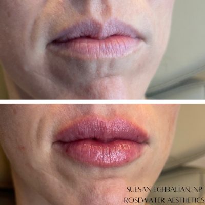 Lip Care Before & After Image | Rosewater Aesthetics in Clarkston, MI