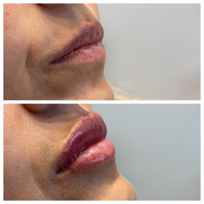 Lip Care Before & After Image | Rosewater Aesthetics in Clarkston, MI