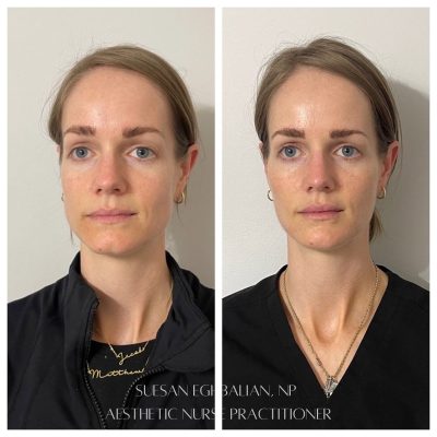 Face Treatment Before & After Image | Rosewater Aesthetics in Clarkston, MI