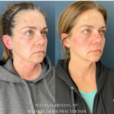 Face Treatment Before & After Image | Rosewater Aesthetics in Clarkston, MI