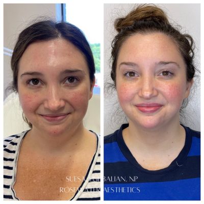 Face Treatment Before & After Image | Rosewater Aesthetics in Clarkston, MI