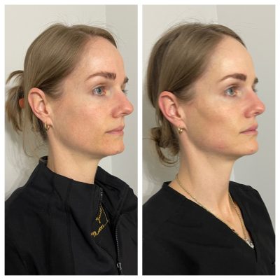 Face Treatment Before & After Image | Rosewater Aesthetics in Clarkston, MI