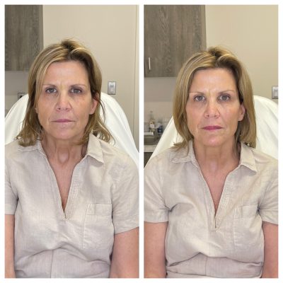 Face Treatment Before & After Image | Rosewater Aesthetics in Clarkston, MI